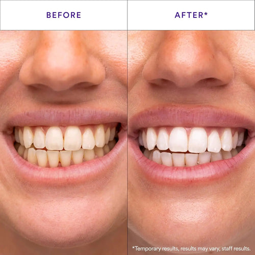 Hismile V34 Whitening Strips, Teeth Whitening Strips, Purple Tooth Whitening, Purple V34 Whitening Strips, Tooth Stain Treatment